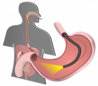Акция! ЭГДС (эзофагогастродуоденоскопия) за 3000 рублей!