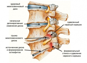 Что делать, если у Вас межпозвоночная грыжа?